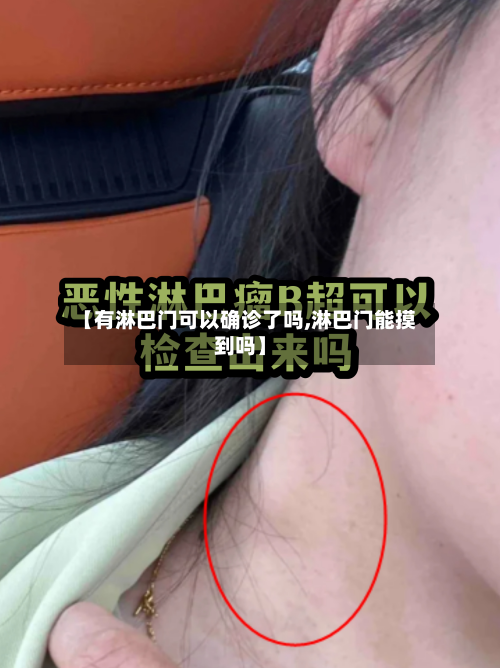 【有淋巴门可以确诊了吗,淋巴门能摸到吗】