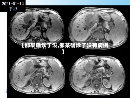 【邵某确诊了没,邵某确诊了没有病例】