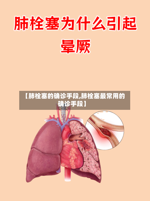 【肺栓塞的确诊手段,肺栓塞最常用的确诊手段】