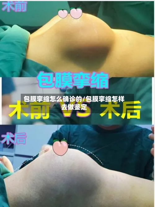 包膜挛缩怎么确诊的/包膜挛缩怎样去做鉴定