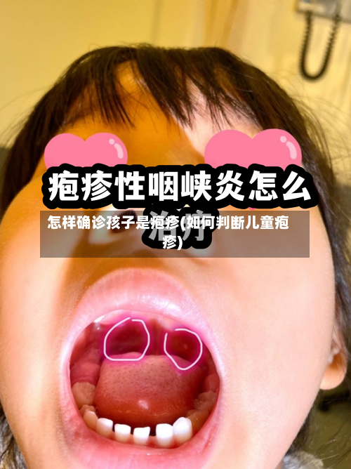 怎样确诊孩子是疱疹(如何判断儿童疱疹)