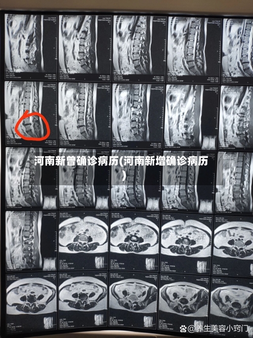 河南新曾确诊病历(河南新增确诊病历)