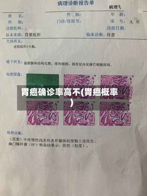 胃癌确诊率高不(胃癌概率)