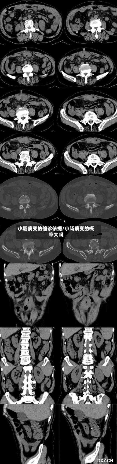 小肠病变的确诊依据/小肠病变的概率大吗