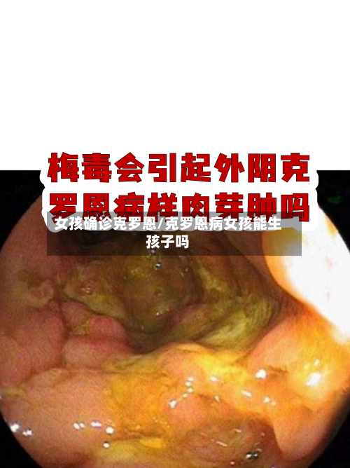 女孩确诊克罗恩/克罗恩病女孩能生孩子吗