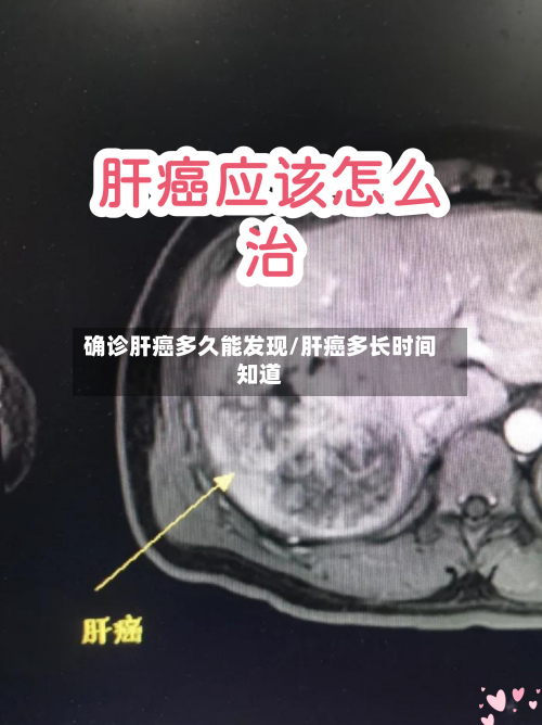 确诊肝癌多久能发现/肝癌多长时间知道