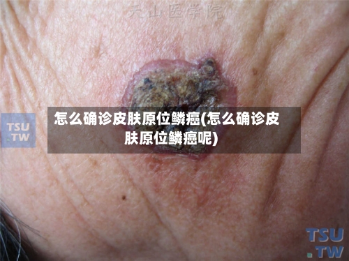 怎么确诊皮肤原位鳞癌(怎么确诊皮肤原位鳞癌呢)