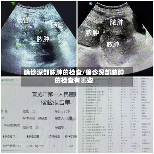 确诊深部脓肿的检查/确诊深部脓肿的检查有哪些