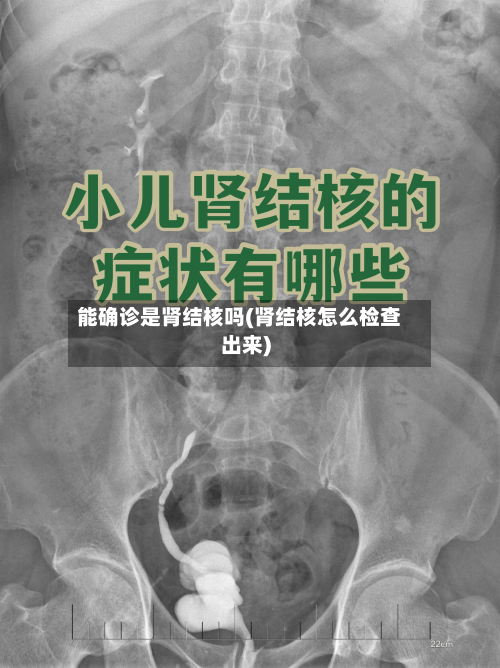 能确诊是肾结核吗(肾结核怎么检查出来)