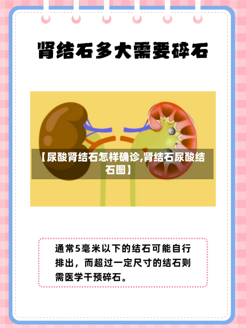 【尿酸肾结石怎样确诊,肾结石尿酸结石图】