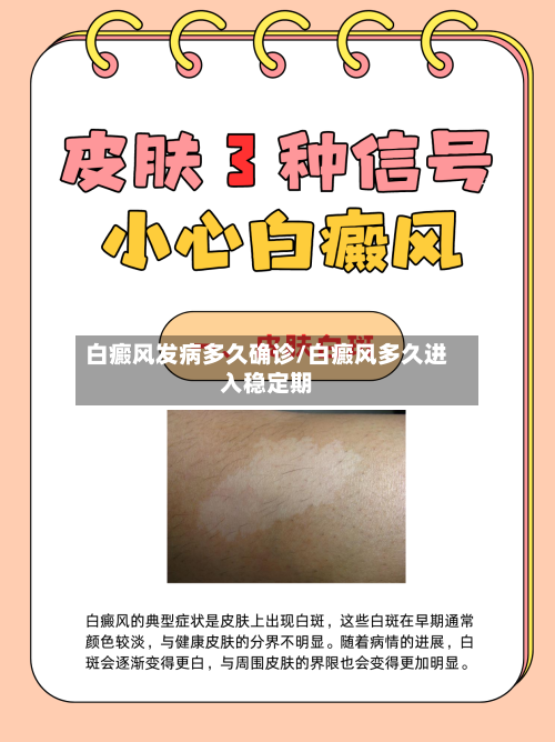 白癜风发病多久确诊/白癜风多久进入稳定期